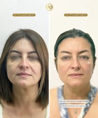 Rejuvenecimiento Facial - Dra. Carmen Padilla