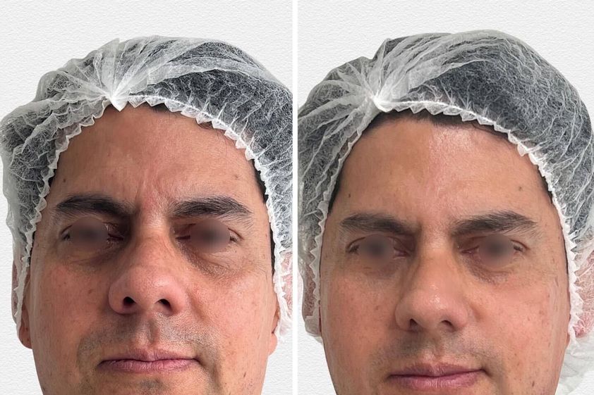 Ácido hialurónico antes y después - 867183