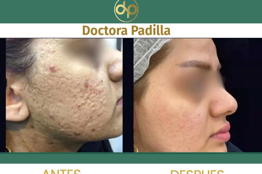 Cicatrices antes y después - 873751