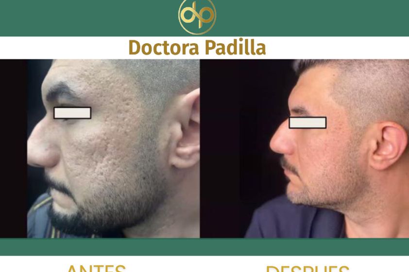 Cicatrices antes y después - 873752