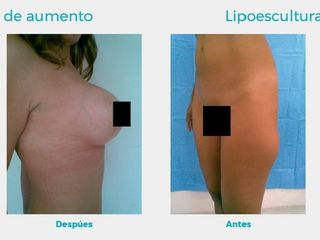 Mamoplastia de aumento y lipoescultura de gluteos
