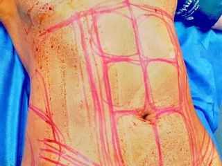 Diseño de una marcación de abdomen