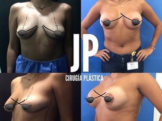 Mamoplastia de aumento 