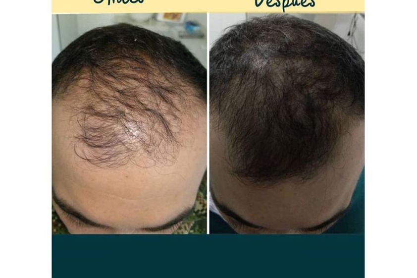 Alopecia antes y después - 648725