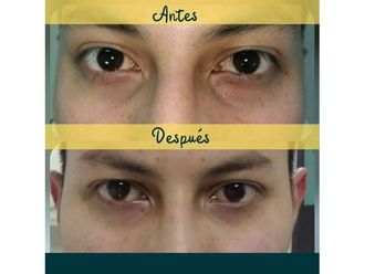 Eliminar ojeras - 648734