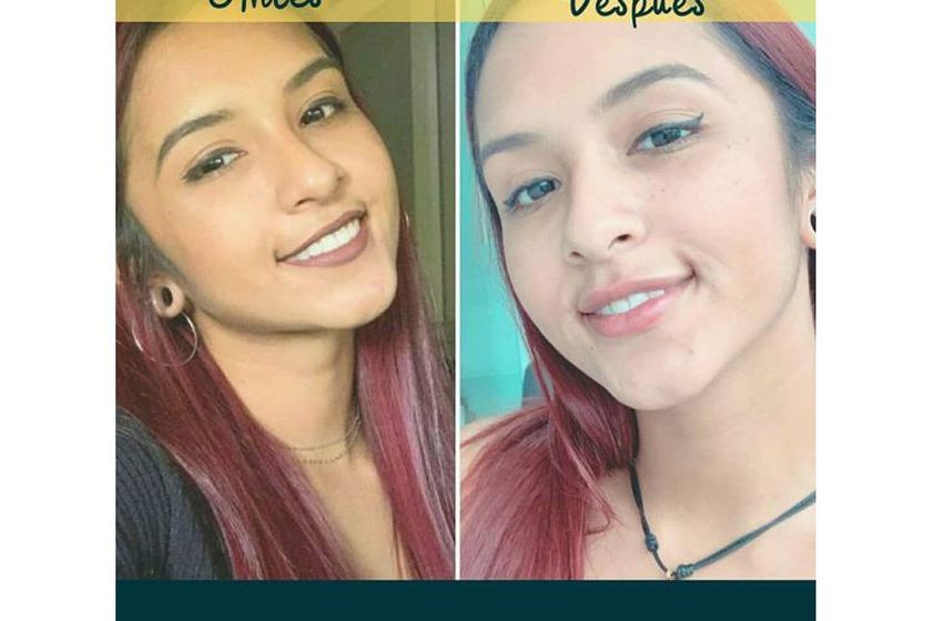 Aumento de labios antes y después - 648736