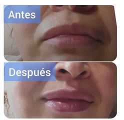Aumento de labios - Dr. Fabian Correa