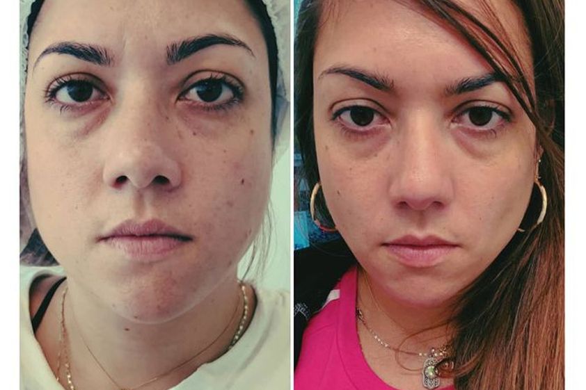 Bichectomía antes y después - 789746