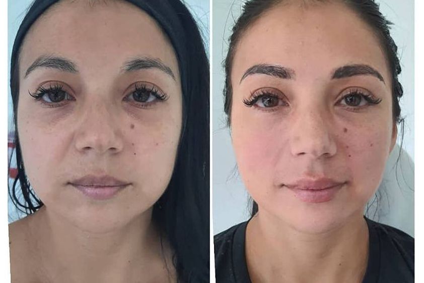 Bichectomía antes y después - 789748