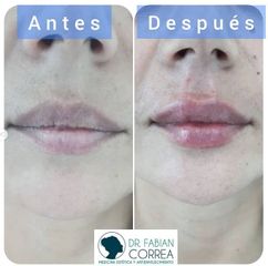 Aumento de labios - Dr. Fabian Correa
