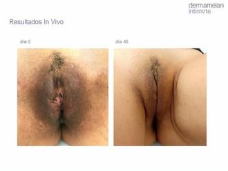 Vaginoplastia antes y después - 789955