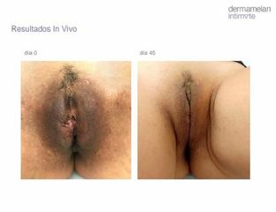 Vaginoplastia - Dr. Fabian Correa