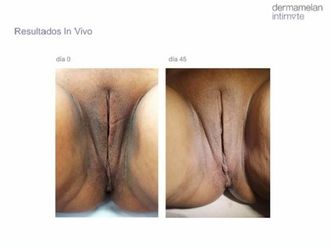 Vaginoplastia antes y después - 789957