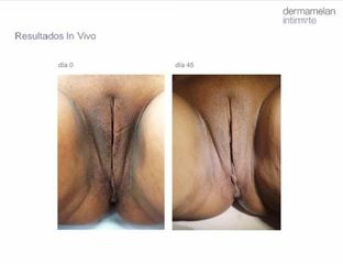 Vaginoplastia - Dr. Fabian Correa