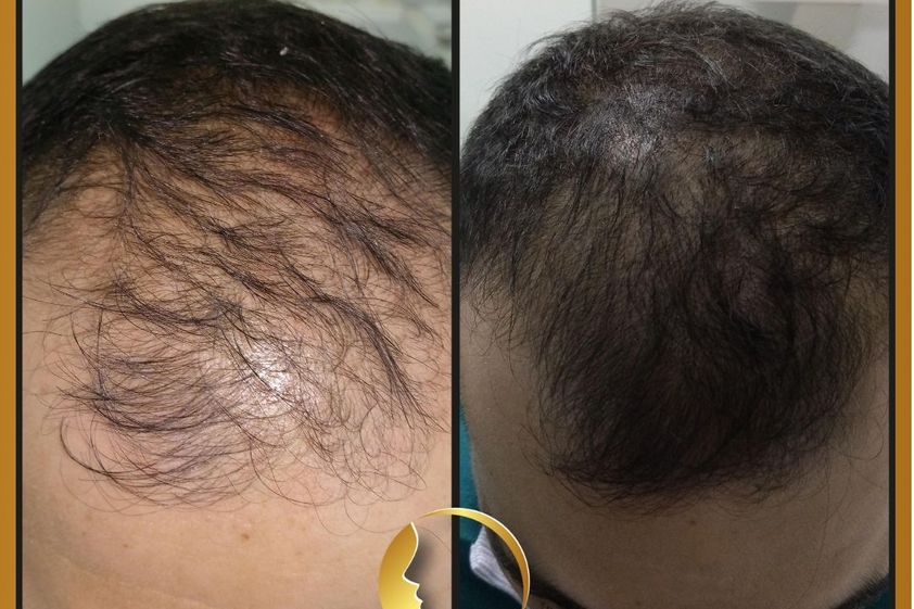 Alopecia antes y después - 799048