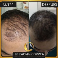 Alopecia - Dr. Fabian Correa