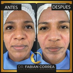 Ácido hialurónico - Dr. Fabian Correa