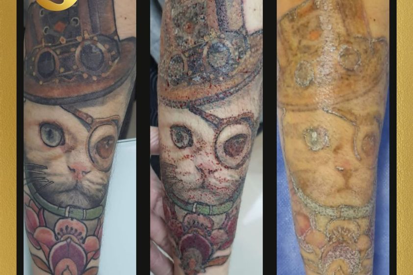 Borrar tatuajes antes y después - 799050