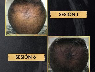 Alopecia - 799051