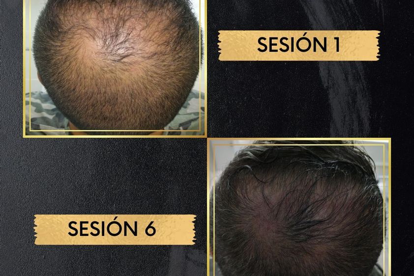 Alopecia antes y después - 799051