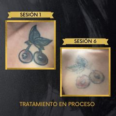 Borrar tatuajes - Dr. Fabian Correa