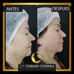 Cirugía de papada - Dr. Fabian Correa