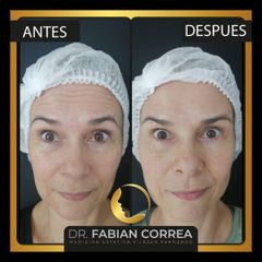 Toxina Botulínica - Dr. Fabian Correa