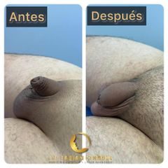 Alargamiento de pene - Dr. Fabian Correa