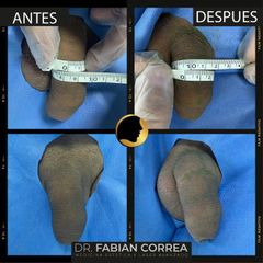 Ensanchamiento de pene - Dr. Fabian Correa