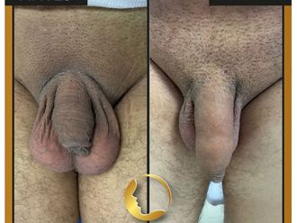 Alargamiento de pene antes y después - 826291