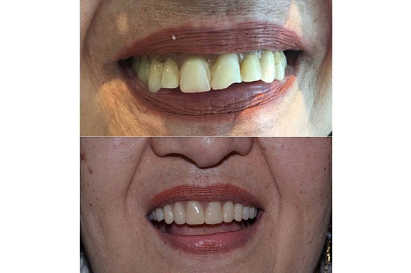 Implantes dentales antes y después - 689963