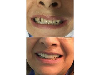 Implantes dentales - Clínica Oral A1