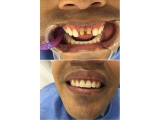 Implantes dentales - Clínica Oral A1