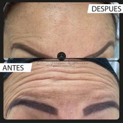 Bótox - Dr. Jeisson Gutiérrez Cañas