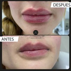 Aumento de labios - Dr. Jeisson Gutiérrez Cañas