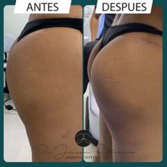 Celulitis - Dr. Jeisson Gutiérrez Cañas