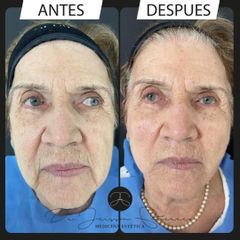 Rejuvenecimiento facial - Dr. Jeisson Gutiérrez Cañas