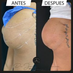 Hilos tensores en gluteos - Dr. Jeisson Gutiérrez Cañas