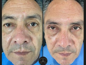 Rejuvenecimiento facial - 799850