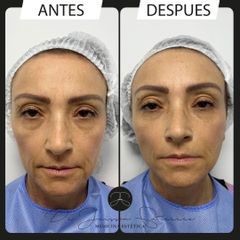 Lifting Facial con hilos tensores - Dr. Jeisson Gutiérrez Cañas