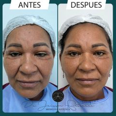 Lifting facial - Dr. Jeisson Gutiérrez Cañas
