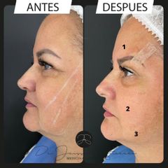 Lifting facial - Dr. Jeisson Gutiérrez Cañas