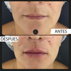 Hidratación de labios - Dr. Jeisson Gutiérrez Cañas