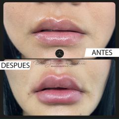 Aumento de labios - Dr. Jeisson Gutiérrez Cañas