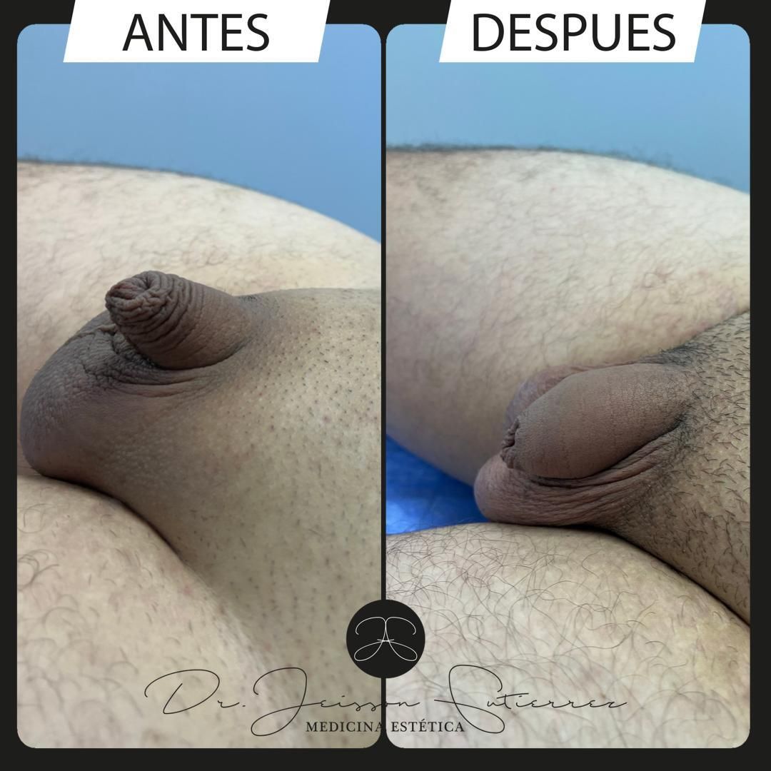 Alargamiento de pene Antes y después - Clinicasesteticas.com.co -  Clinicasesteticas.com.co