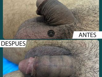 Alargamiento de pene antes y después - 823590