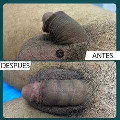Aumento de pene - Dr. Jeisson Gutiérrez Cañas