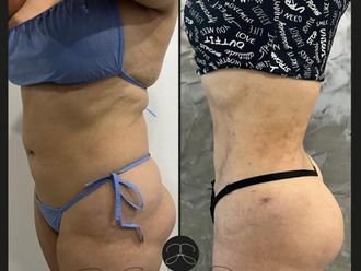 Lipólisis láser antes y después - 860004