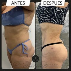 Lipólisis láser - Dr. Jeisson Gutiérrez Cañas