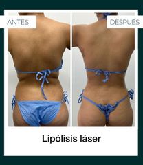 Lipólisis láser - Dr. Jeisson Gutiérrez Cañas